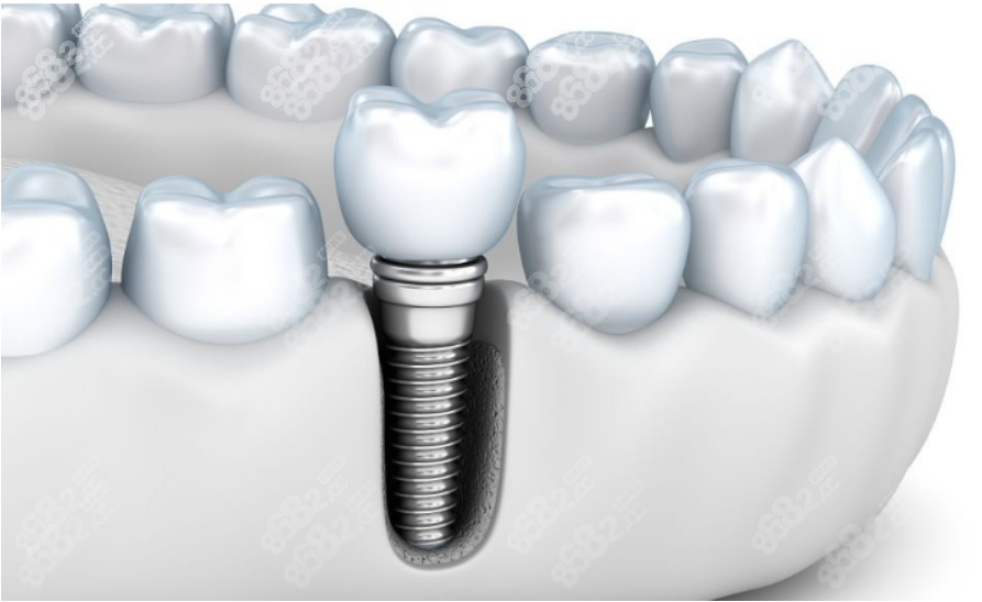 种植牙