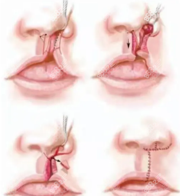 余文林医生唇裂修复实例反馈