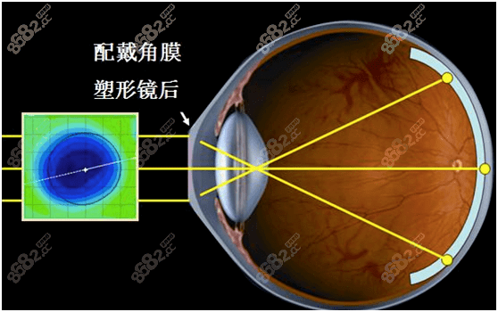 角膜塑形镜的利与弊有哪些8682.cc