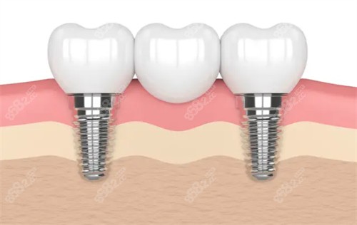 珠海拜博口腔種植牙口碑不錯(cuò)