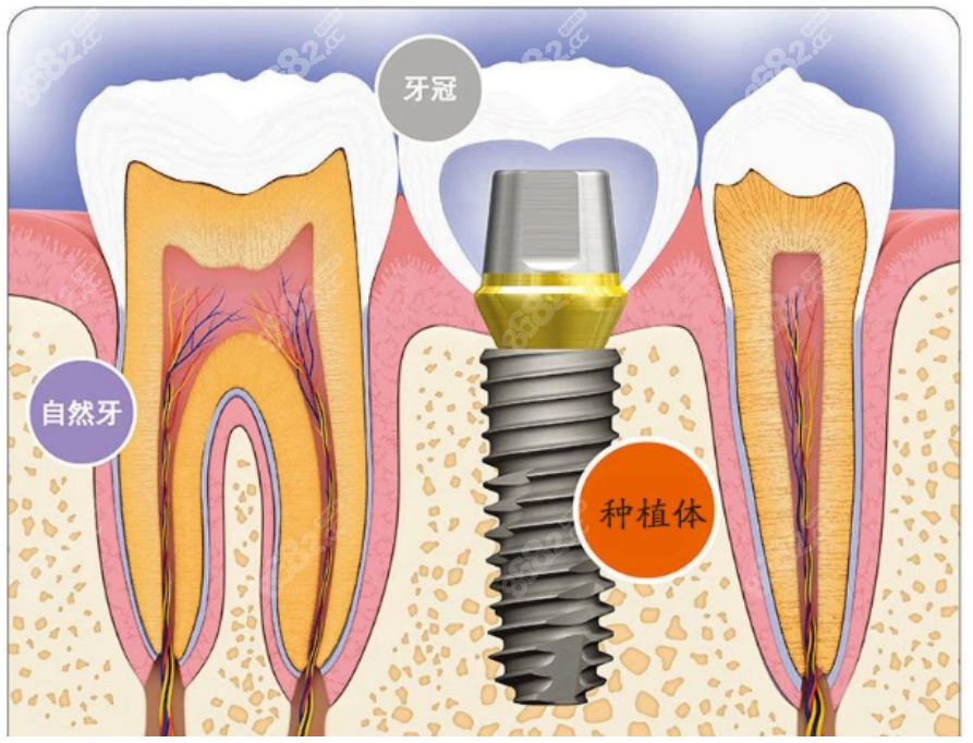 种植牙