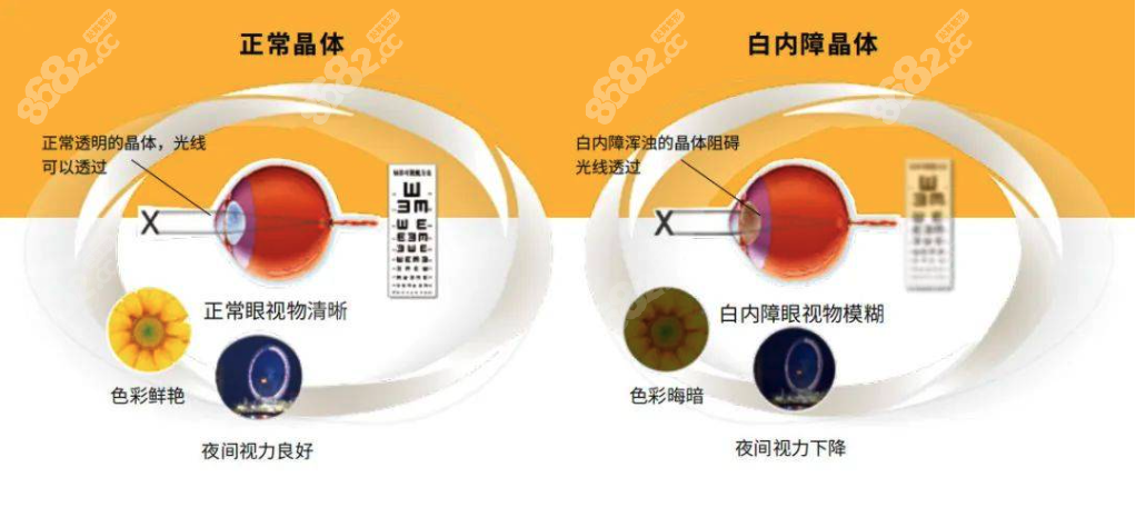 三焦晶体植入适合先天性白内障患者吗