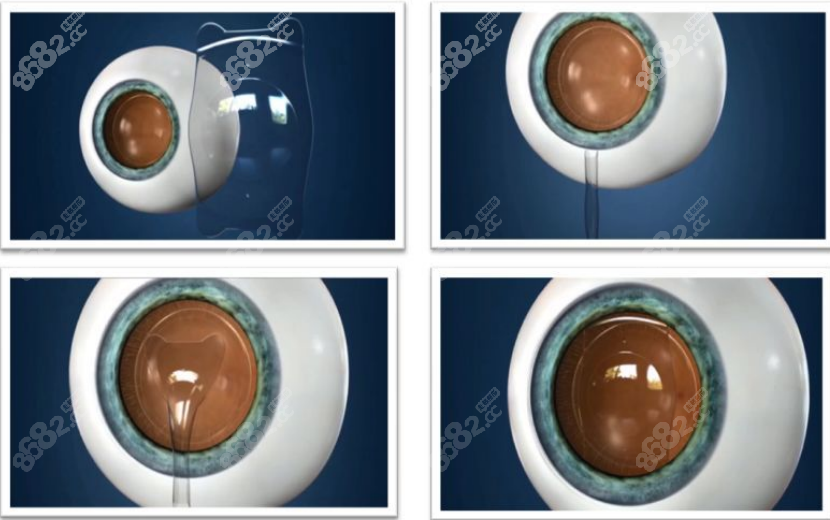 杭州做icl晶体植入好的医院排名