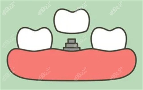 珠海拜博口腔種植牙技術(shù)成熟