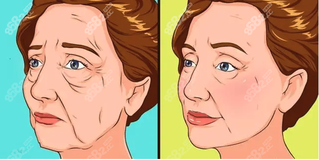 輪廓固定提升面部到底有沒有副作用呢