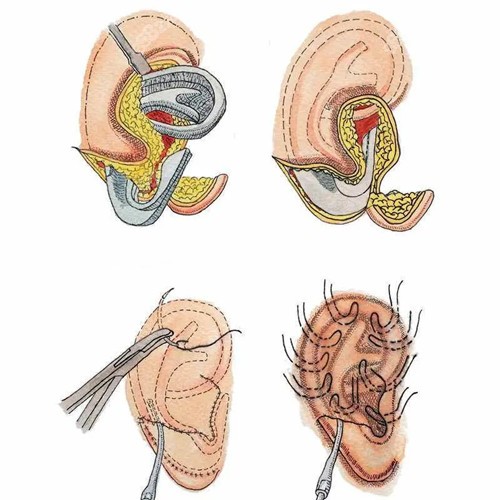 耳再造直埋法手术过程