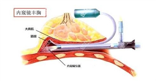 吴毅平隆胸价格是多少？