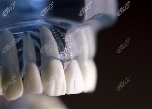 种植牙图示
