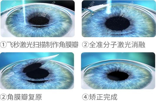 保定高碑店德仁眼科医院近视手术多少钱