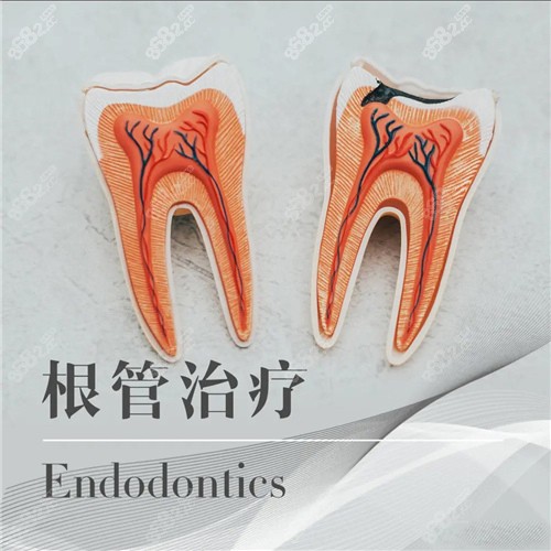 根管治疗动画图