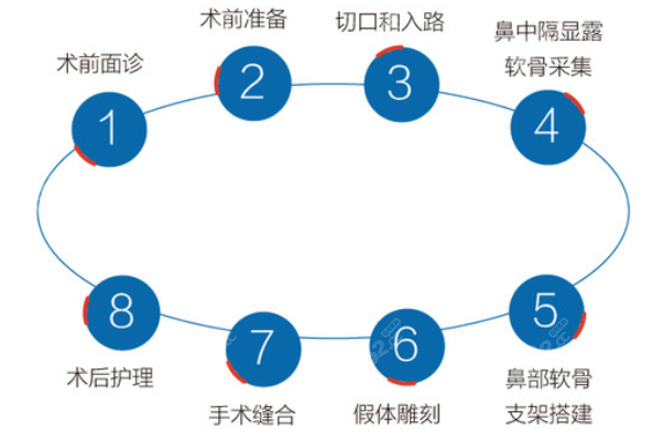 杭州李保锴医生隆鼻过程图解