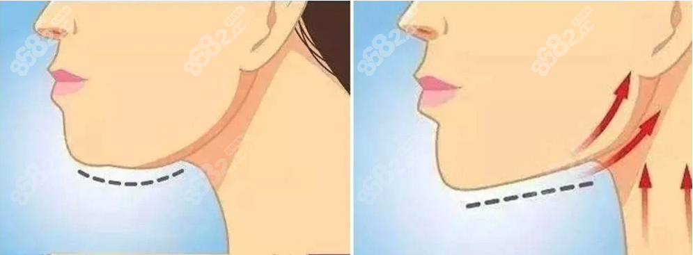 面部輪廓固定提升到底有沒有副作用呢