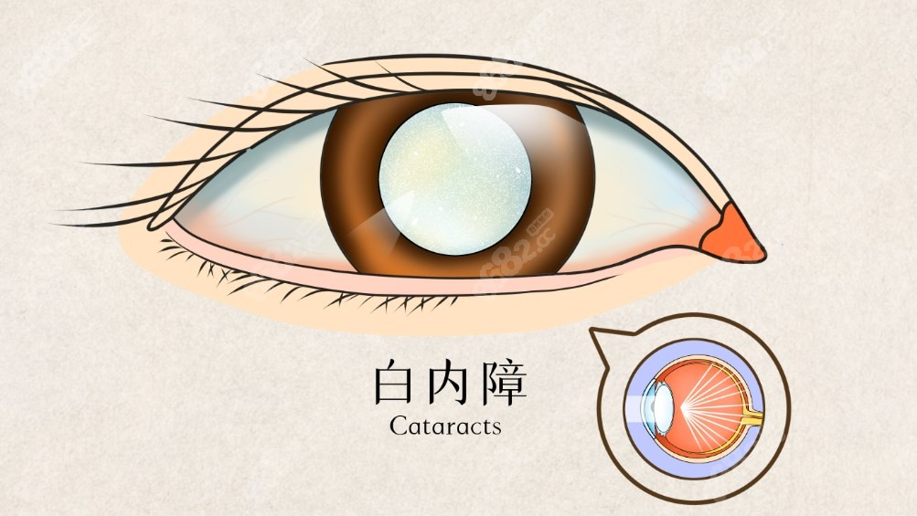 白內(nèi)障手術(shù)