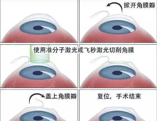 成都近视眼手术过程