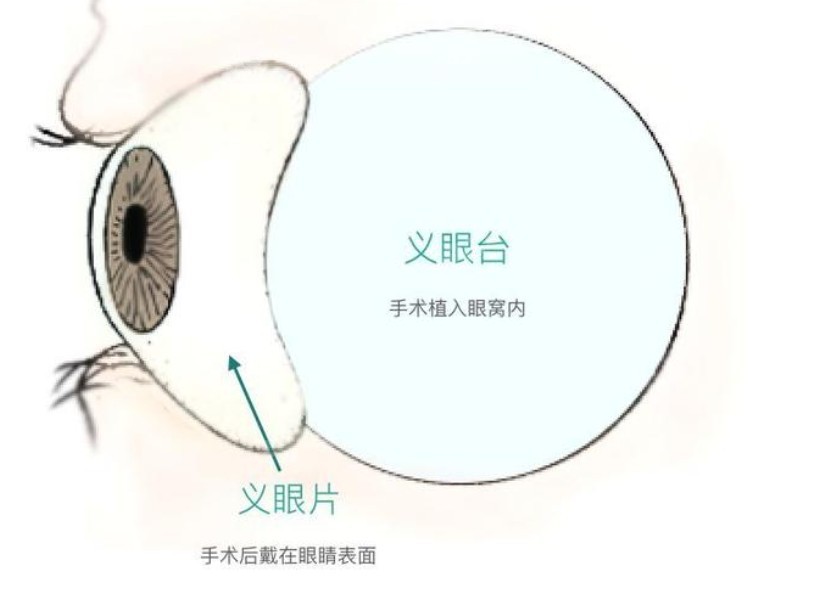 愛爾眼科義眼片比義眼臺價格便宜