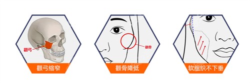 北京圣嘉新醫(yī)療美容醫(yī)院張立天醫(yī)生顴骨顴弓手術(shù)特色
