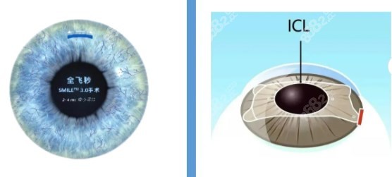 飛秒和晶體植入