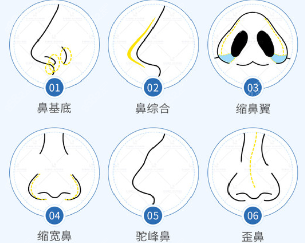 如何和李保锴沟通隆鼻喜好 8682.cc