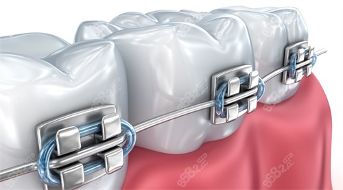 牙齿矫正动画图