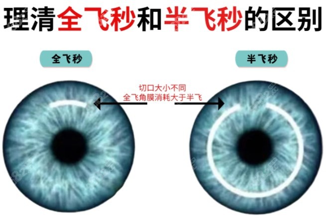 庞辰久医生做全飞秒和半飞秒手术区别图