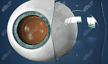 晶体植入近视手术图