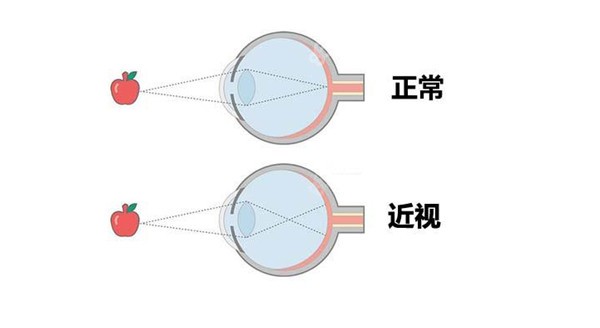 宁波太学眼科近视手术优势