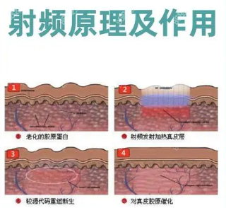 电波拉皮和射频到底有何不同