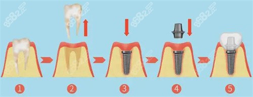 种植牙全过程图