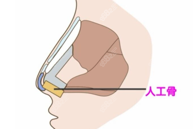 上海华美隆鼻医生哪个好