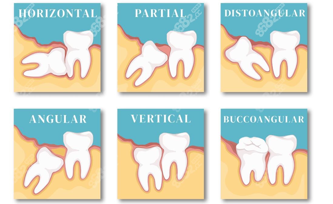 智齿生长位置不同拔除难度不同