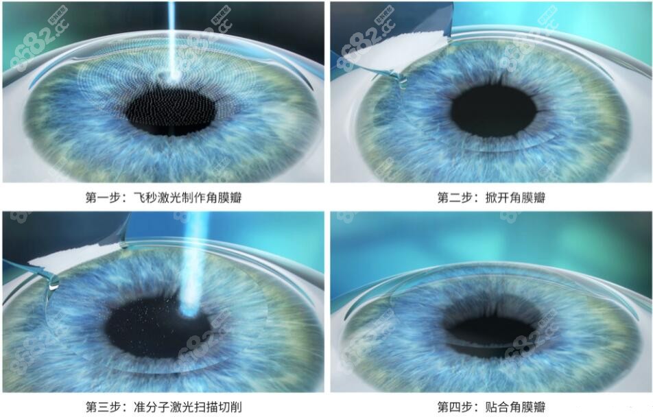 <!--<i data=20240705-sp></i>-->医生做近视矫正手术实例