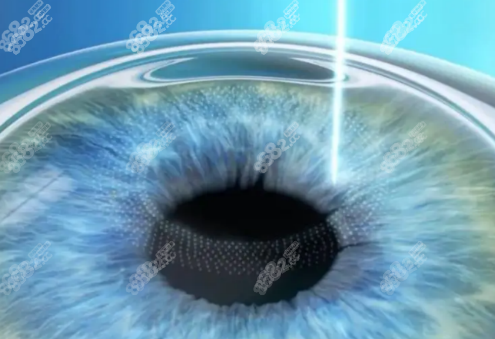 新视界眼科激光手术