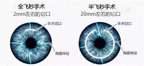 重庆新视野眼科医院屈光手术价格