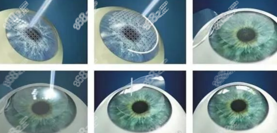 新视界眼科激光手术