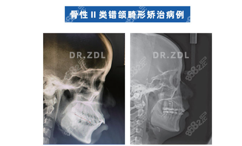 北京张栋梁医生做骨性牙齿凸嘴矫正怎么样