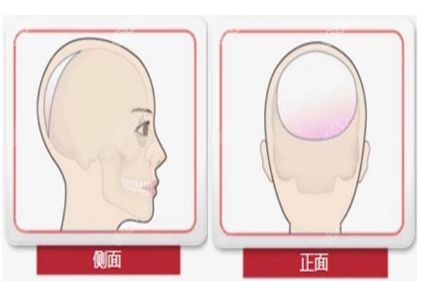 颅骨整形疗效图