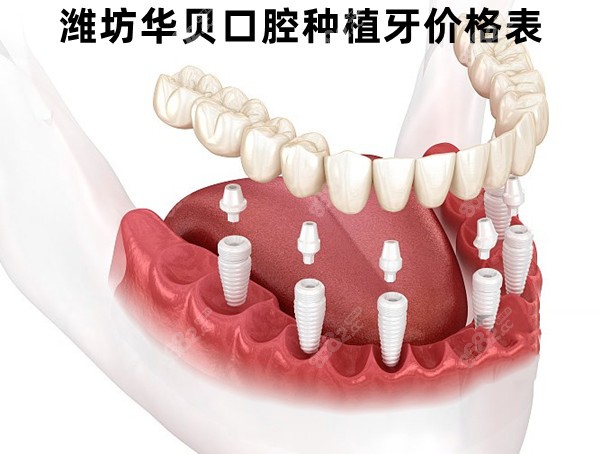 潍坊华贝口腔全口种植牙价格表