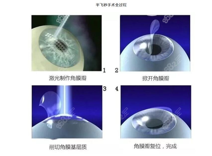 半飞秒手术过程