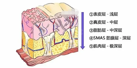 v美减龄面部提升弊