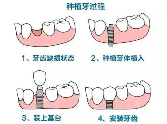 种植牙详细过程www.8682.cc