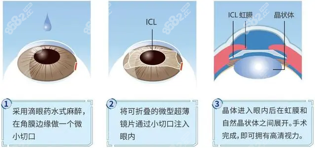 宁财文医生做白内障晶体植入手术好