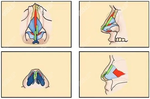 隆鼻整形手术细节图