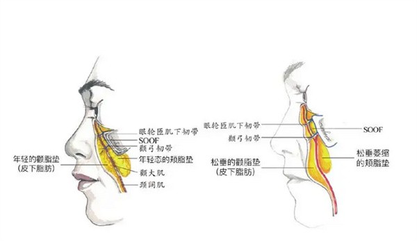 psv面部提升是什么一种技术