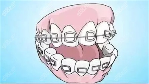 南京德福口腔医院牙齿矫正多少钱？