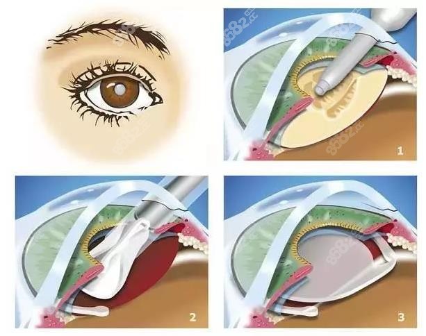 <!--<i data=20240705-sp></i>-->眼科白内障手术操作过程图