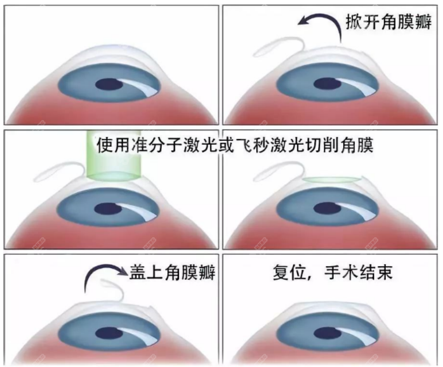 深圳华厦眼科医院近视眼手术