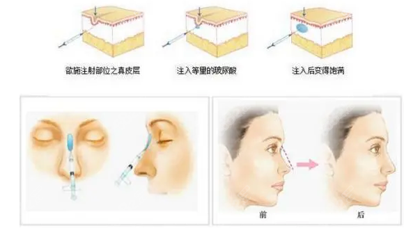 润洛薇玻尿酸注射鼻子