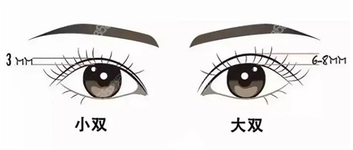 北京三仁整形周敏茹做双眼皮口碑好