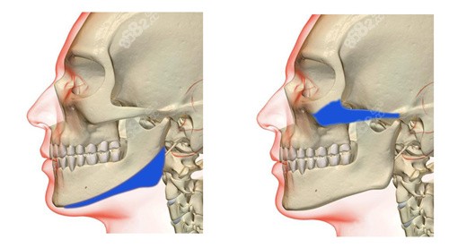 下颌角整形和颧骨整形