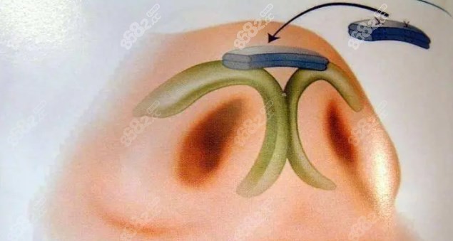 譚曉燕鼻綜合實例 譚曉燕鼻綜合實例